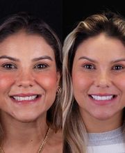 Lente de Contato Dental, Dr. Marcelo Borille imagen 13