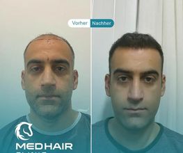 MedHair Clinic | Haartransplantationen in der Türkei Istanbul Bild 8
