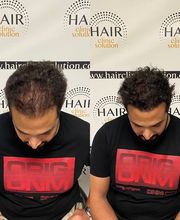 Hair clinic solution spécialiste en micropigmentation du cheveux à Marseille image 5