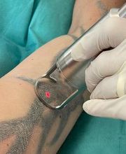 ENDLICH OHNE Tattooentfernung Filiale Wolfenbüttel Bild 1