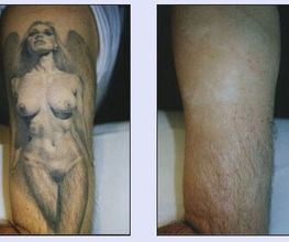 Tattooentfernung VN 5.jpg