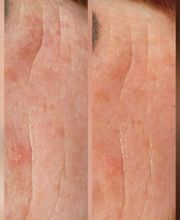 MOÈ Nails & Beauty Hautbehandlung in Augsburg mit sichtbaren Anti-Aging-Effekten für glatte Haut.