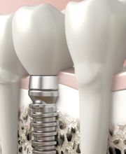 Praxis für Oralchirurgie und Implantologie Zürich Dr. Georg Damerau Bild 6