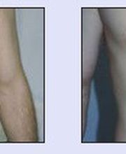 Haarentfernung VN 3.jpg