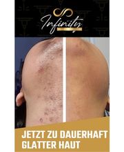 infinity Haarentfernung Bild 2