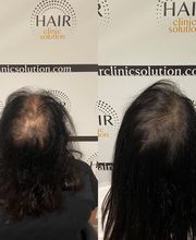 Hair clinic solution spécialiste en micropigmentation du cheveux à Marseille image 4