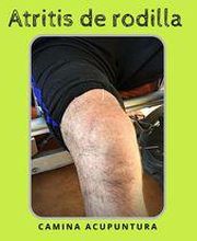 artritisrodillaacupunturqa.jpg