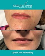 ENDLICH OHNE Tattooentfernung Filiale Landshut Bild 11