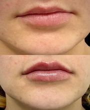 Juvenalia Brío | Botox, Hydrafacial & Ultraformer - Condesa / Roma Norte CDMX imagen 4