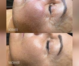 Sara_Pavo_Cosmetics_kristallmicrodermabrasion_essen.jpg