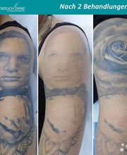 ENDLICH OHNE Tattooentfernung Filiale Landshut Bild 12