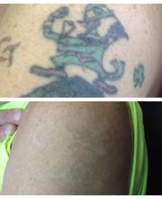 Removery Tattoo Removal & Fading image 9