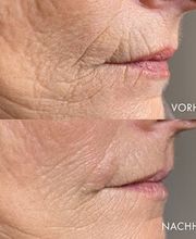 Medizinisches Needling