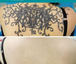ENDLICH OHNE Tattooentfernung Filiale Dresden/Pirna Bild 3