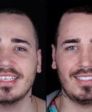 Lente de Contato Dental, Dr. Marcelo Borille imagen 11