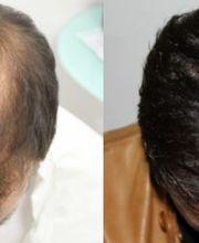 Transplantieren schonend Haare Basel Region Narben Haartransplantation