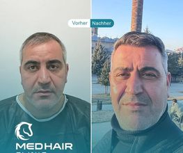 MedHair Clinic | Haartransplantationen in der Türkei Istanbul Bild 13