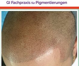 Microhaar Pigmentierung 068-