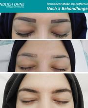 ENDLICH OHNE Tattooentfernung Filiale Leipzig Bild 6