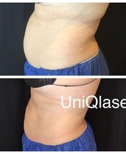 UniQ Laser Center Watertown image 18