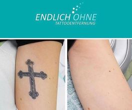 ENDLICH OHNE Tattooentfernung Berlin Bild 6