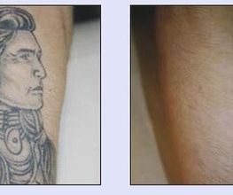 Tattooentfernung VN 1.jpg