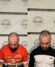 Hair clinic solution spécialiste en micropigmentation du cheveux à Marseille image 7