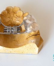 manchegos-protesis-dental-disyuntor-03.jpg