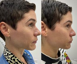 Juvenalia Brío | Botox, Hydrafacial & Ultraformer - Condesa / Roma Norte CDMX imagen 10