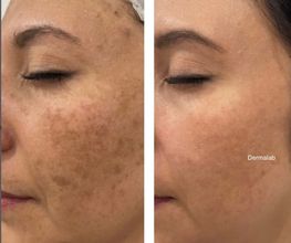 dermapen-mahalahonda-madrid.jpg