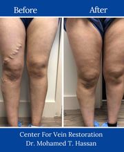 Center for Vein Restoration | Dr. Mohamed Hassan image 8