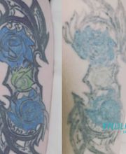ENDLICH OHNE Tattooentfernung Filiale Heilbronn Bild 6