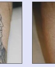 Tattooentfernung VN 1.jpg