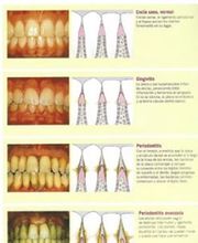 enfermedad-periodontal-05.jpg