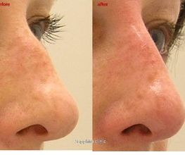 Rhinoplastie médicale