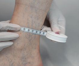 Knöchelmessung Angiologie Pratteln