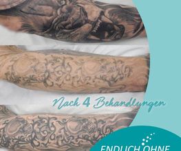ENDLICH OHNE Tattooentfernung Filiale Wilhelmshaven Bild 1