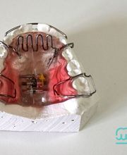 manchegos-protesis-dental-removible-04.jpg
