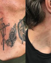 Removery Tattoo Removal & Fading image 4
