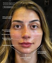 Instituto Marzola | Harmonização Facial imagen 11