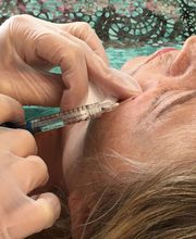 Augenringe Hyaluronspritzung.jpg