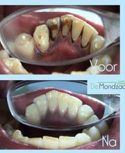 Een extreem voorbeeld van de binnenkant van de tanden, maar dit soort resultaten behalen we met regelmaat! Hoe mooi kan het worden.