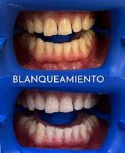 Milaaguilarclinicadental-balnqueamiento.jpg