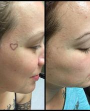 Removery Tattoo Removal & Fading image 5