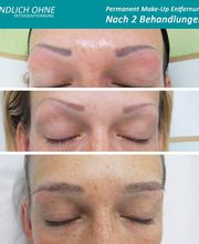 ENDLICH OHNE Tattooentfernung Filiale Leipzig Bild 4