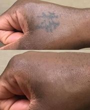 Removery Tattoo Removal & Fading image 8