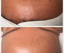Resultaat na 1x HydroPeptide behandeling