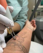 ENDLICH OHNE Tattooentfernung Filiale Brilon Bild 5