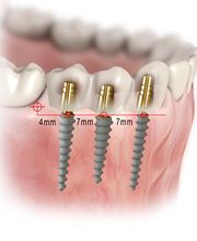 Clínica de Estética dental Láser .Algeciras.Dr Joaquín garcia rodriguez imagen 5