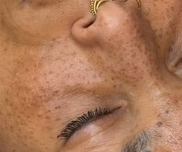 Fake Freckles - Skink Studio - Studio für Permanent Make-up in Köln